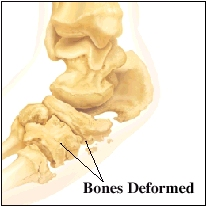 Image of foot bones showing deformed bones