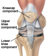 Image of a knee prosthesis