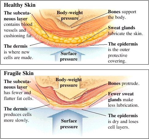 Healthy skin has a subcutaneous layer that contains blood vessels and cushioning fat. The dermis is where new cells are made. Bones support the body. Sweat glands lubricate the skin. The epidermis is the outer protective covering. Surface pressure is balaned by body weight pressure. In fragile skin, the subcutaneous layer has fewer and flatter fat cells. Bones protrude. Fewer sweat glands make less lubrication. The epidermis is dry and loses cell layers. The dermis produces cells more slowly. Surface pressure can result in sores.