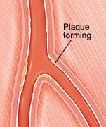 Cross section of peripheral artery with damaged lining.