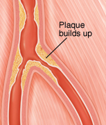 Cross section of peripheral artery narrowed by plaque buildup.