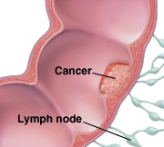 Cross section of colon and lymph nodes, showing cancer inside colon.