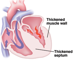 Image of a heart with a thickened septum and muscle wall.