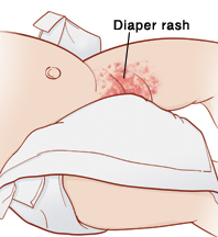 Closeup of diaper on baby, partly undone to show diaper rash on inner thigh.