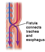 Side view of trachea and esophagus showing tracheoesphageal fistula.
