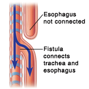 Side view of trachea and esophagus showing combination of fistula and artresia.