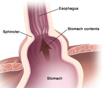 Closeup of diaphragm with large opening allowing top of stomach and sphincter to move up into chest cavity. Stomach contents flow up into esophagus.
