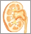 Image of kidney stones