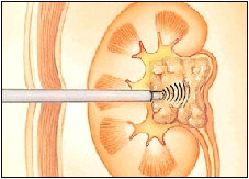 Image of an instrument to crack the kidney stone