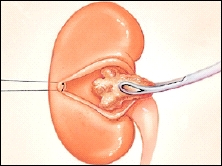 Image of an open kidney and stone removal