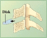 Cross section of cervical vertebrae showing disk being removed.