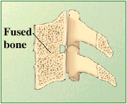 Cross section of cervical vertebrae showing fused bone between vertebrae.