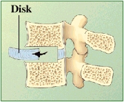 Cross section of lumbar vertebrae showing disk being removed.