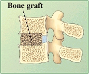 Cross section of lumbar vertebrae showing bone graft between vertebrae.