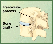 Cross section of lumbar vertebrae showing fused bone between transverse processes.