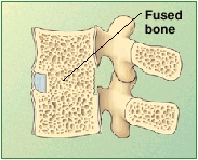 Cross section of lumbar vertebrae showing fused bone between vertebrae.