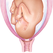 Front view of fetus in uterus showing cervix beginning to thin and open in preterm labor.