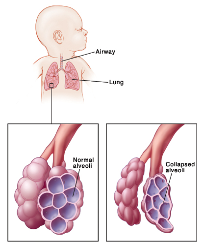 Baby with head turned to side showing airway and lungs. Closeup of airway and normal alveoli. Closeup of airway and collapsed alveoli.