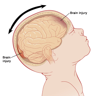 Side view of baby with head tilted back, showing brain inside. Arrows show head moving back and forth, and injuries at front and back of brain.