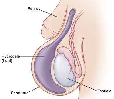 Closeup of baby's penis and scrotum showing testicle inside. Large sac of fluid (hydrocele) is inside scrotum and enlarging it.