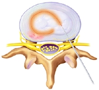 Image of the catheter heating the disk.