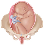 Breech posistion showing the baby's feet or buttocks first