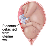 Placenta abruption showing the placenta detached from the uterine wall
