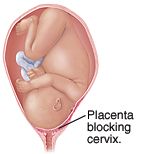 Placenta previa showing the placenta blocking the cervix