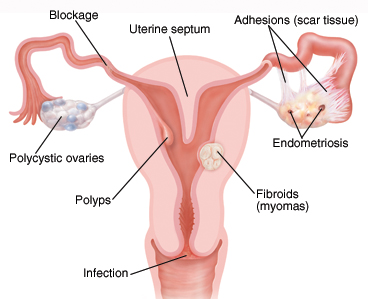Cross section front view of vagina, cervix, uterus, fallopian tubes, and ovaries. One ovary shows polycystic ovary. Blockage is in fallopian tube. Fibroid (myoma) is growing in wall of uterus. Endometriosis tissue is on ovary. Adhesions connect ovary to fallopian tube. Septum is wall of tissue inside uterus. Polyp is growing from wall of uterus. Infection is on cervix.