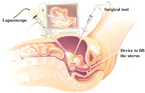 Side view cross section of female pelvis showing laparoscope and surgical tool inserted in abdomen. Device to lift uterus is inserted in vagina and is holding on to cervix. Video monitor in background.