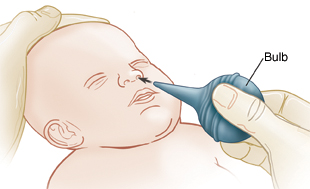 Hand inserting bulb into baby's nose. Other hand is holding baby's head steady.