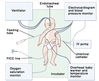 Top view of baby in incubator showing endotracheal tube in nose going to ventilator. Leads on chest go to electrocardiogram and blood pressure monitor. Umbilical catheter inserted near belly button goes to IV pump. Temperature sensor on abdomen goes to overhead baby warmer and temperature monitor. Sensor wrapped around foot is connected to oxygen saturation monitor. PICC line is inserted into inner thigh. Feeding tube is inserted in mouth.