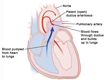 Patent Ductus Arteriosus (pda) In Premature Infants