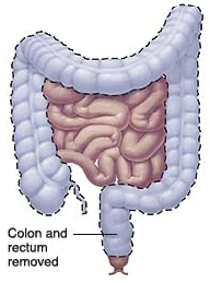 Image of the intestines with the colon and rectum highlighted to show the section to be removed.