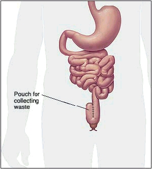 Image showing the intestinal pouch for collecting waste