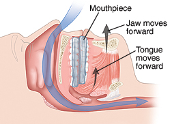 Cross section side view of head showing mouthpiece fitting over teeth. Mouthpiece causes jaw and tongue to move forward. Arrow shows air flowing freely through nose and throat.