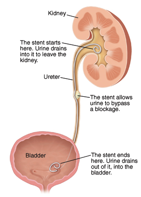 Cross section of kidney, ureter, and bladder with stent in place. Stent starts in kidney. Urine drains into it to leave kidney. Stent allows urine to bypass blockage in ureter. Stent ends in bladder. Urine drains out of it into the bladder.