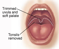 Front view of open mouth showing tissues trimmed during UPPP.