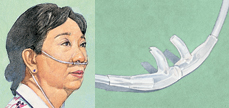 Woman wearing a nasal cannula and up close image of nasal cannula