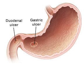 When Your Child Has a Gastric or Duodenal Ulcer