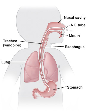Outline of baby with head turned to side showing mouth, esophagus, stomach, nasal cavity, trachea (windpipe), and lungs. NG tube is inserted in nose, through esophagus, and into stomach.