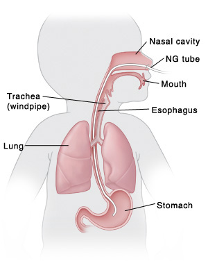 The NG tube is inserted through your child’s nose, down the esophagus, and into the stomach. Outline of baby with head turned to side showing mouth, esophagus, stomach, nasal cavity, trachea (windpipe), and lungs. NG tube is inserted in nose, through esophagus, and into stomach.