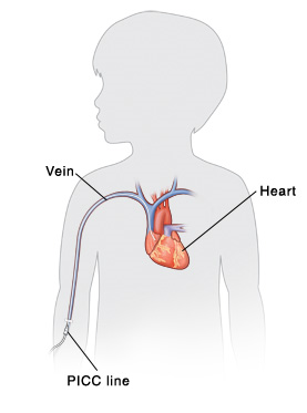 Outline of child showing a PICC line inserted into a vein.