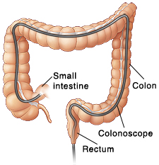 Front view of colon showing scope inserted through anus into entire colon.