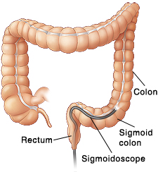 Front view of colon showing scope inserted through anus into sigmoid colon.