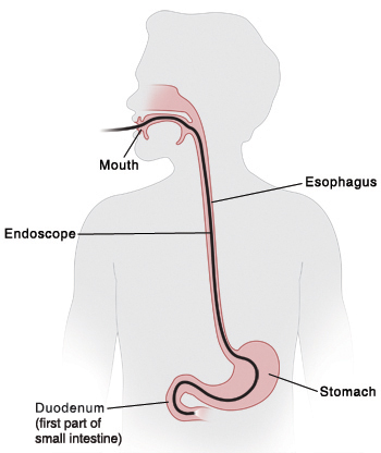 Outline of child with head turned to side showing endoscope inserted into mouth, esophagus, stomach, and ending in duodenum (first part of small intestine).