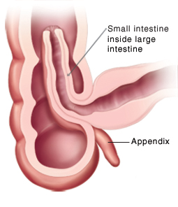 Cross section of intestine showing intussusception.