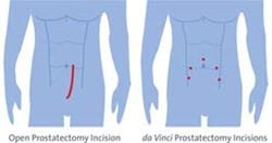 portrayal of incision sites for prostate robotic surgery