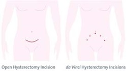 Portrayal of hysterectomy incision sites for robotic surgery