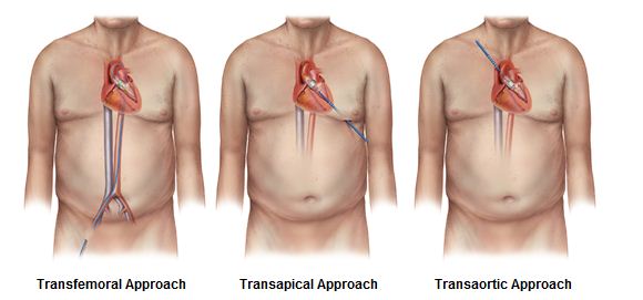 Illustration of three of the options for catheter insertion for TAVR procedure